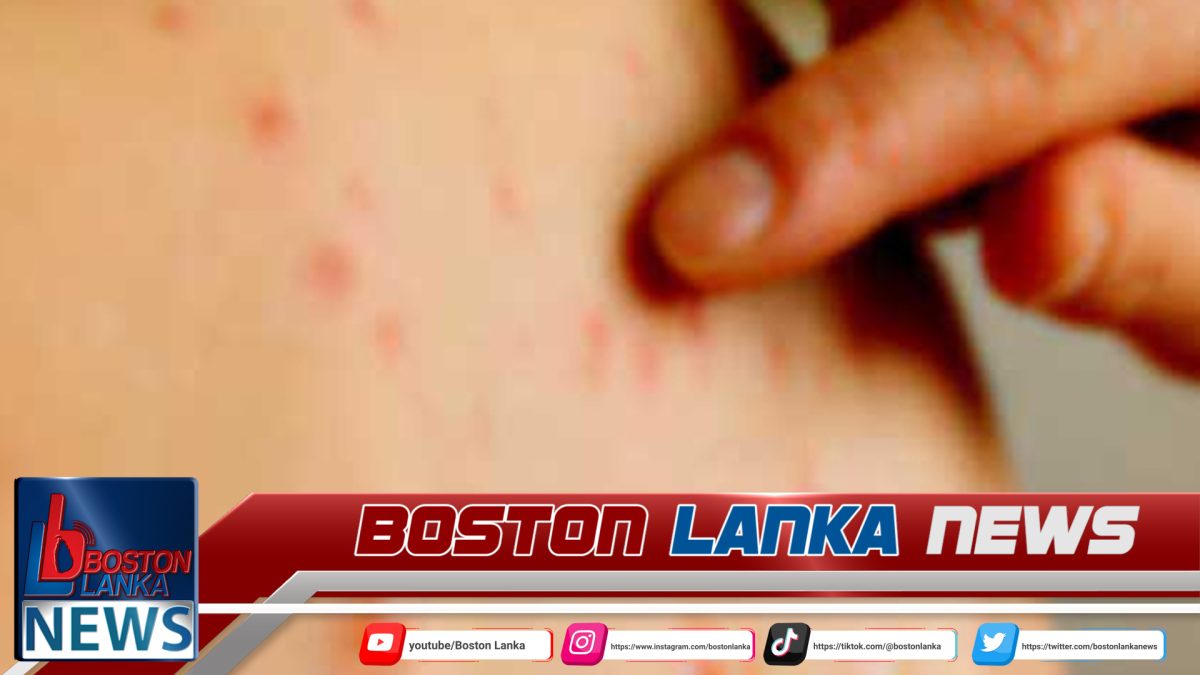 සරම්ප රෝගීන් දෙදෙනෙක් කොළඹින් හමුවෙයි – අනිවාර්යයෙන් එන්නත් ලබාගන්නැයි උපදෙස්……